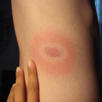 rumień wędrujący od uryzienia klaeszcza